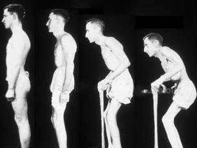 Болезнь Бехтерева. Фото с сайта norb-holod.ru Болезнь Бехтерева. Фото с сайта norb-holod.ru